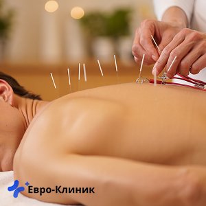 Иглы для лечения